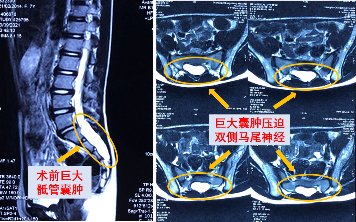 手术后肛门失禁-肛门失禁：术后的阴影与生活的挣扎，我该如何面对？