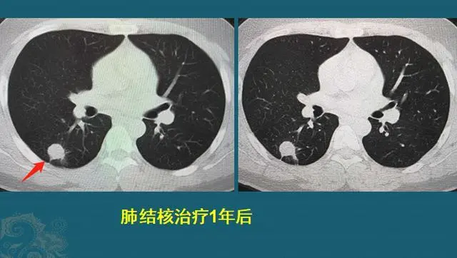 治愈的肺结核会变成肺癌吗_已治愈的肺结核_严重肺结核能治愈吗