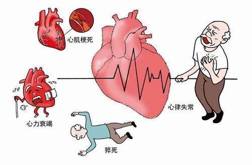 护理冠心病要点有哪些_冠心病的护理要点_护理冠心病患者的注意事项