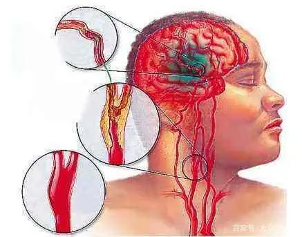 血液感染的症状图片_血液感染有哪些症状_血液感染的图片