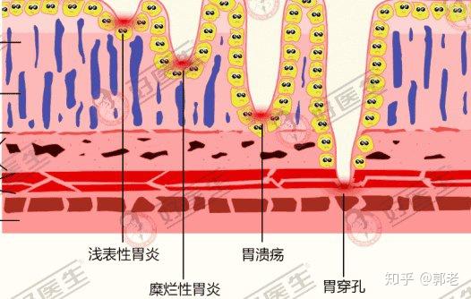 浅表性胃炎用什么药-浅表性胃炎别担心，这些药让你的胃如沐春风