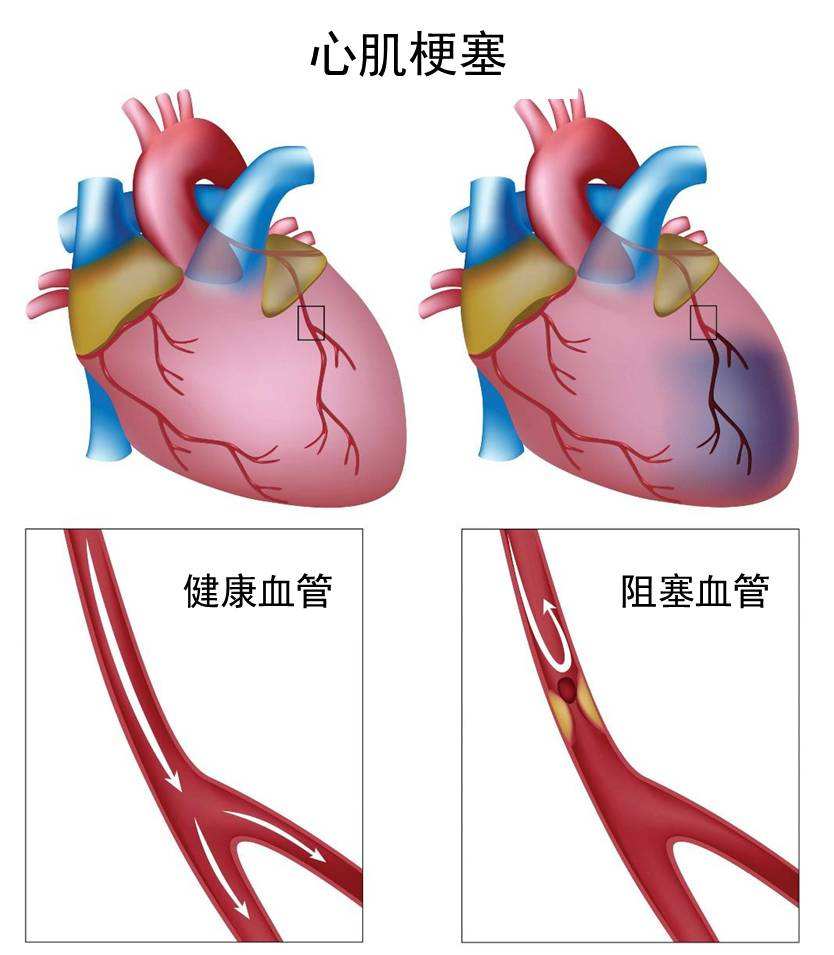 冠心病患者护理措施_冠心病病人的护理措施_冠心病护理措施的总结