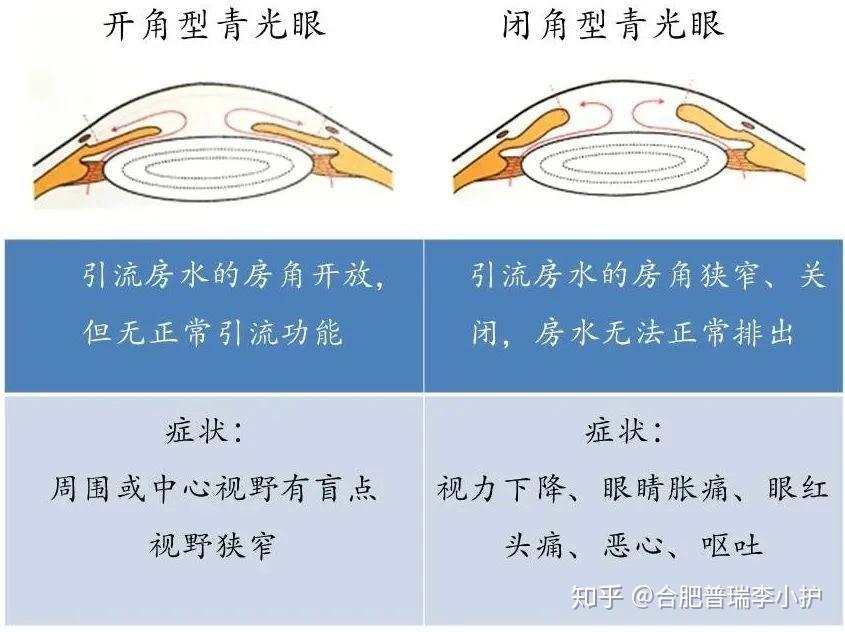 药物性青光眼可以治愈吗_药物性青光眼护理措施_药物相关性青光眼