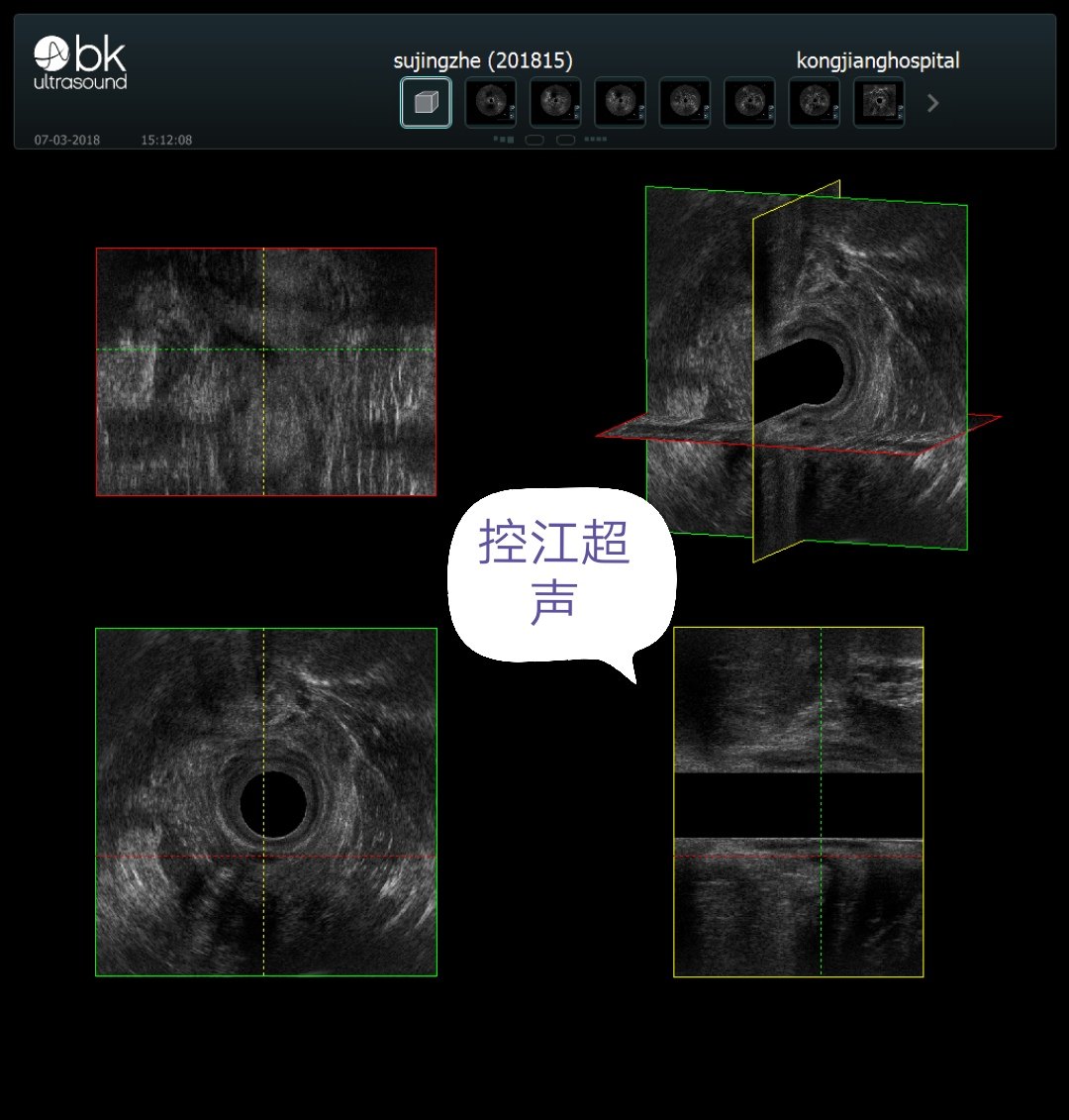 多长手术能好肛瘘时间短_肛瘘手术多长时间长好_肛瘘手术多长时间能好