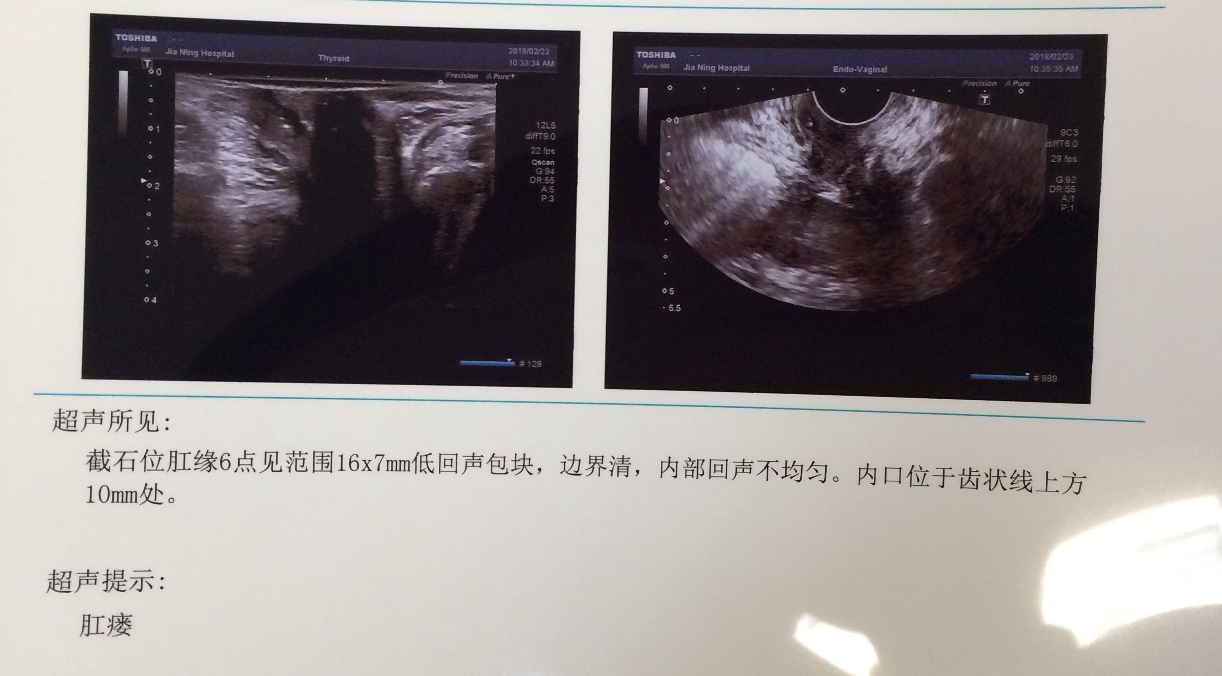 多长手术能好肛瘘时间短_肛瘘手术多长时间长好_肛瘘手术多长时间能好