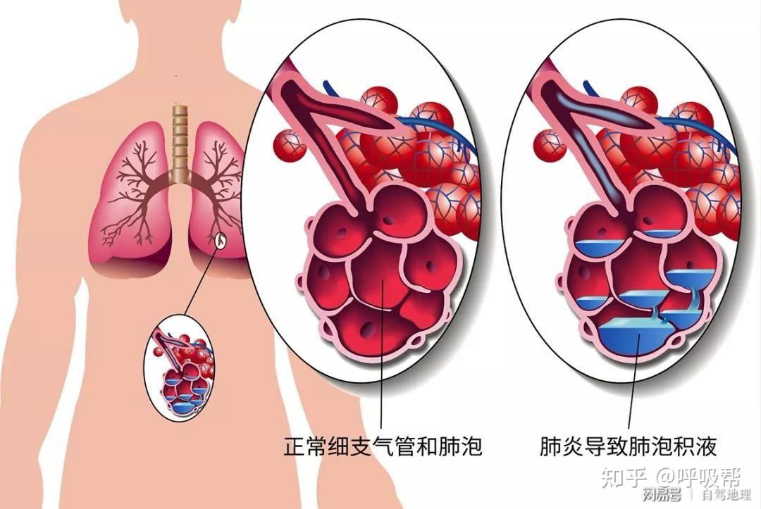 呼吸衰竭定义及可能原因_出现呼吸衰竭的原因是_呼吸衰竭是由于各种原因引起的