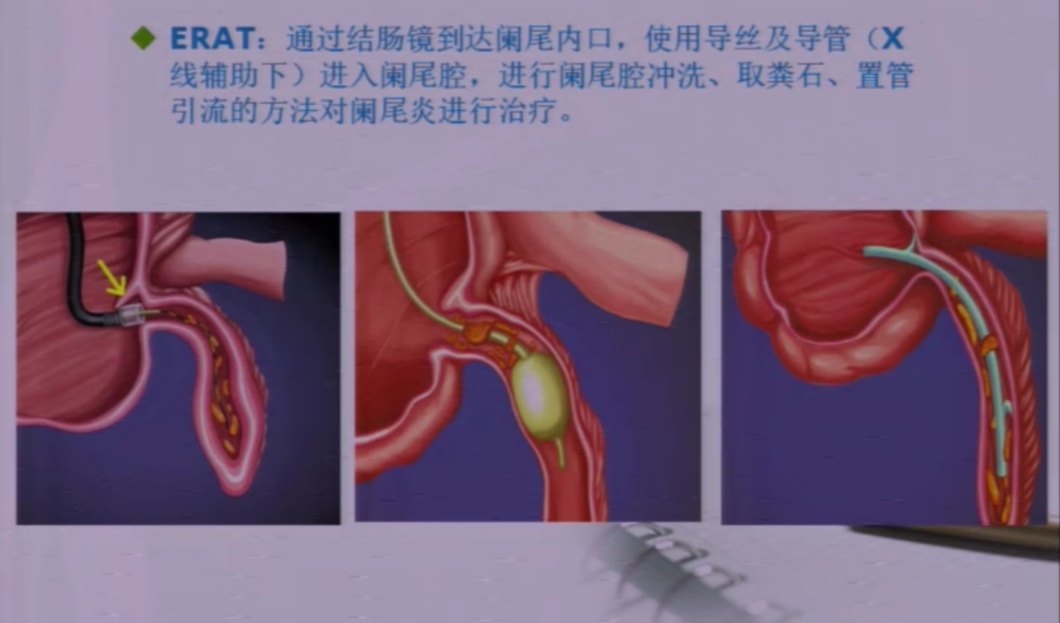 急性阑尾炎术后护理课件_急性阑尾炎术后护理常规ppt_简述急性阑尾炎术后护理