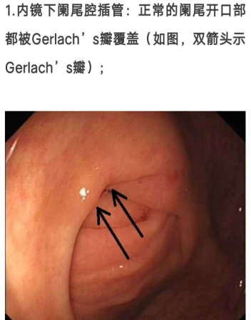 急性阑尾炎术后护理课件_急性阑尾炎术后护理常规ppt_简述急性阑尾炎术后护理