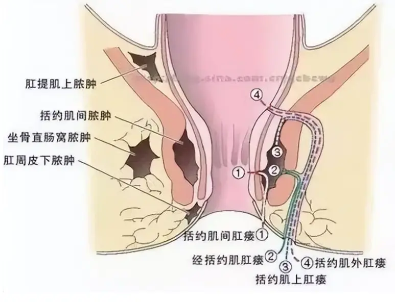 肛瘘手术后多长时间坐浴_多长手术坐浴肛瘘时间后不疼_肛瘘术后坐浴一次多久