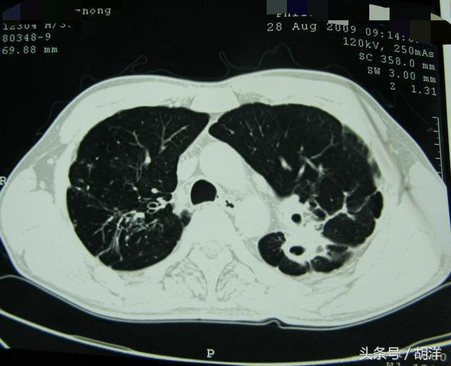 浸润型肺结核属于几型肺结核_浸润性肺结核属于哪型_浸润型肺结核属于几型