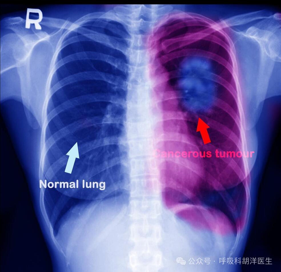 想咳后背疼会不会肺癌_咳嗽后背疼是肺癌吗_咳嗽后背疼是肺炎吗