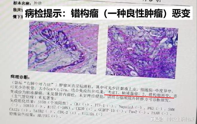 咳嗽后背疼是肺炎吗_咳嗽后背疼是肺癌吗_想咳后背疼会不会肺癌