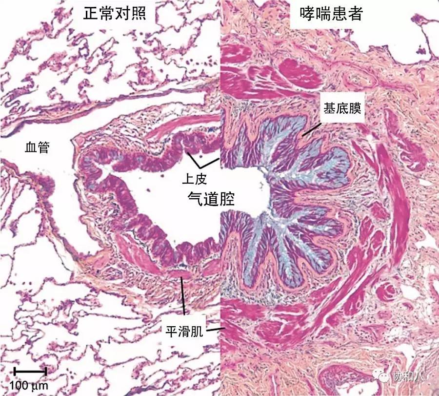 哮喘运动会好吗_哪些运动员有哮喘_哮喘通过运动可以改善吗