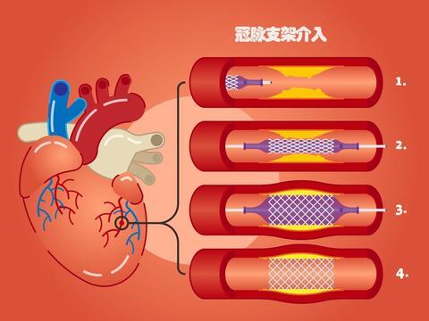 冠心病 治疗-冠心病并非不可战胜，坚持治疗与努力可重获健康